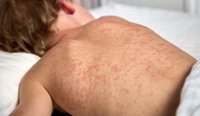 U Federaciji BiH 3000 djece dobilo ospice, u tri županije proglašena epidemija